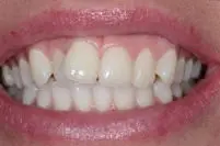 Behandling af skæve tænder