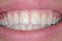 Behandling af skæve tænder efter